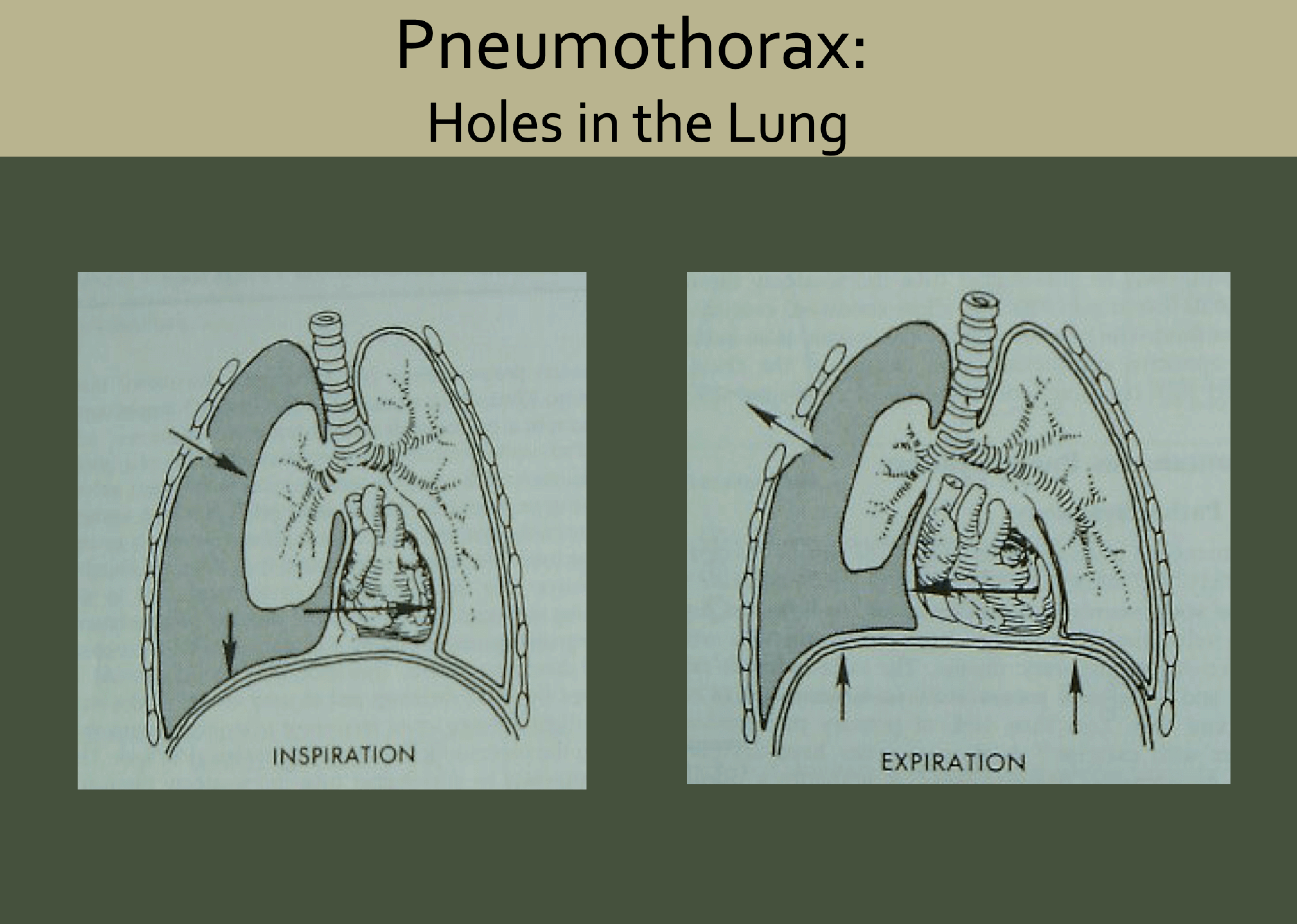 open pneumothorax dressing