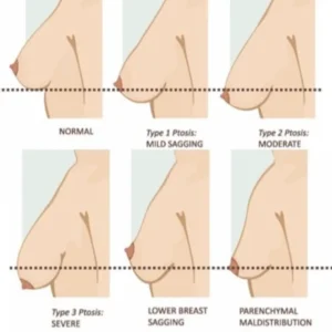 A chart used in plastic surgery to show the different heights of breasts for ptosis evaluation