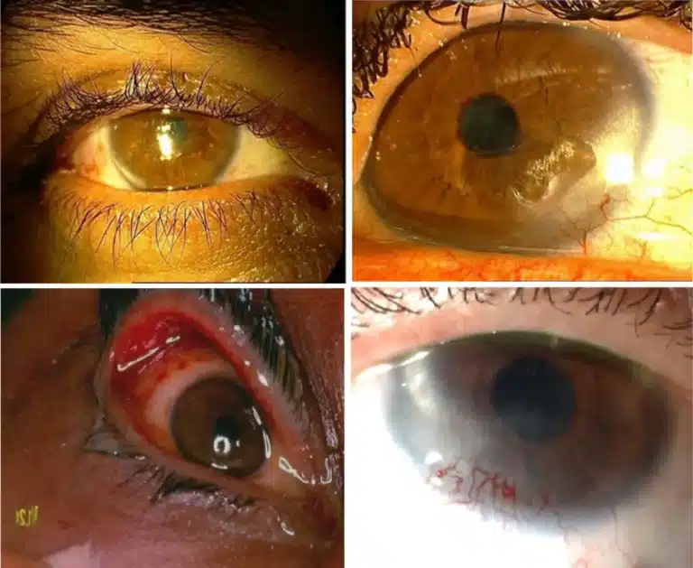 Photographs showing eye findings from sulfur mustard