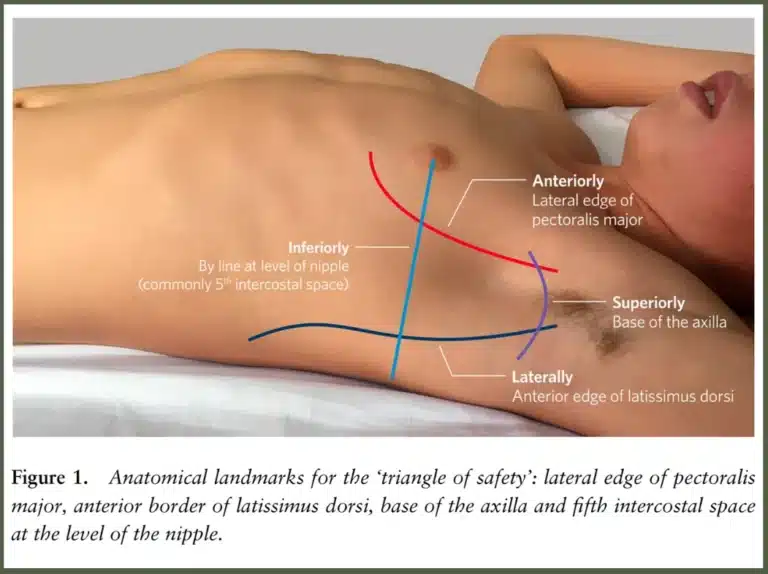 A photograph showing the lateral chest wall of a child with landmarks for needle decompression, highlighting the so-called triangle of safety